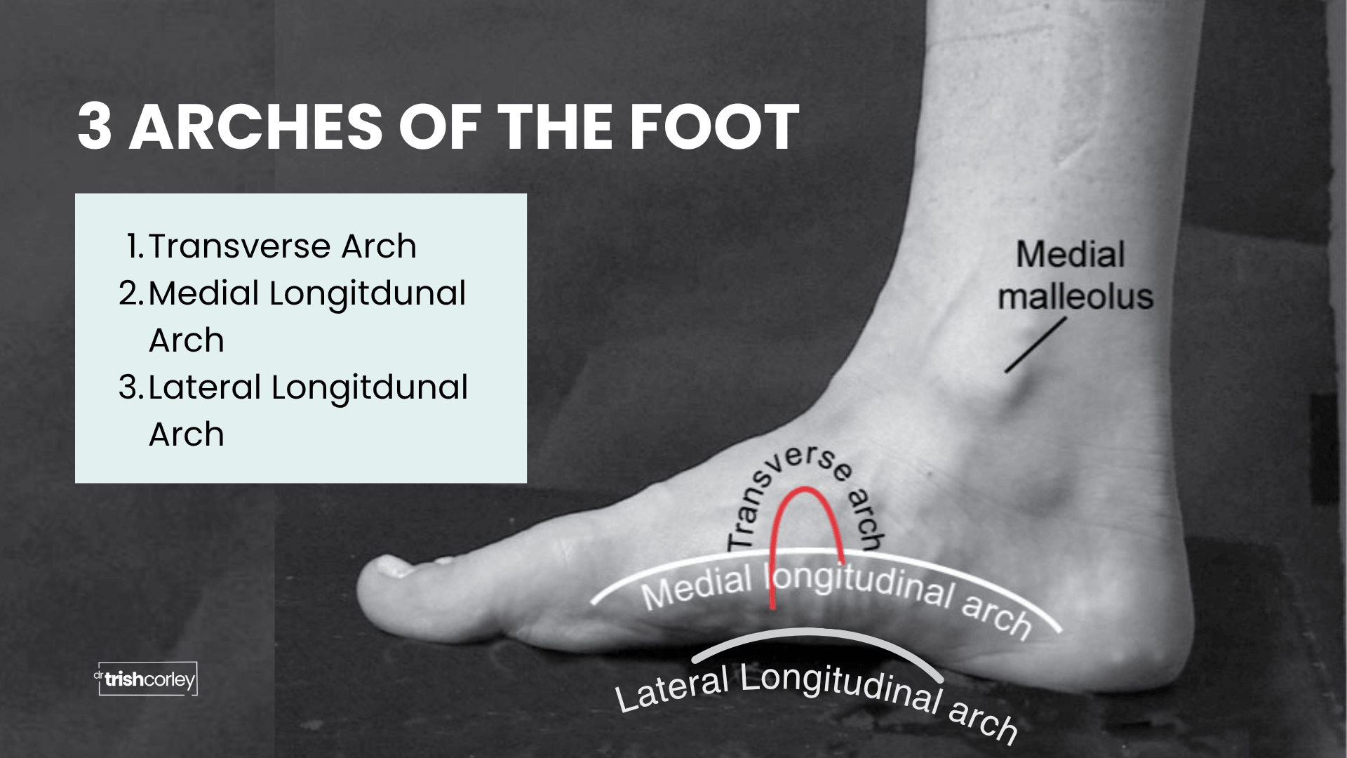 Diagram showing the three arches of the foot including the transverse, medial longitudinal, and lateral longitudinal arch