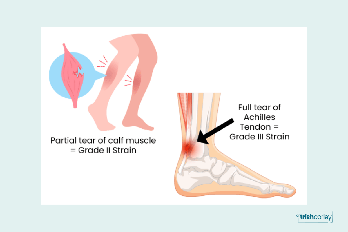 Illustration showing Grade II and Grade III muscle and tendon strain grading for yoga teachers