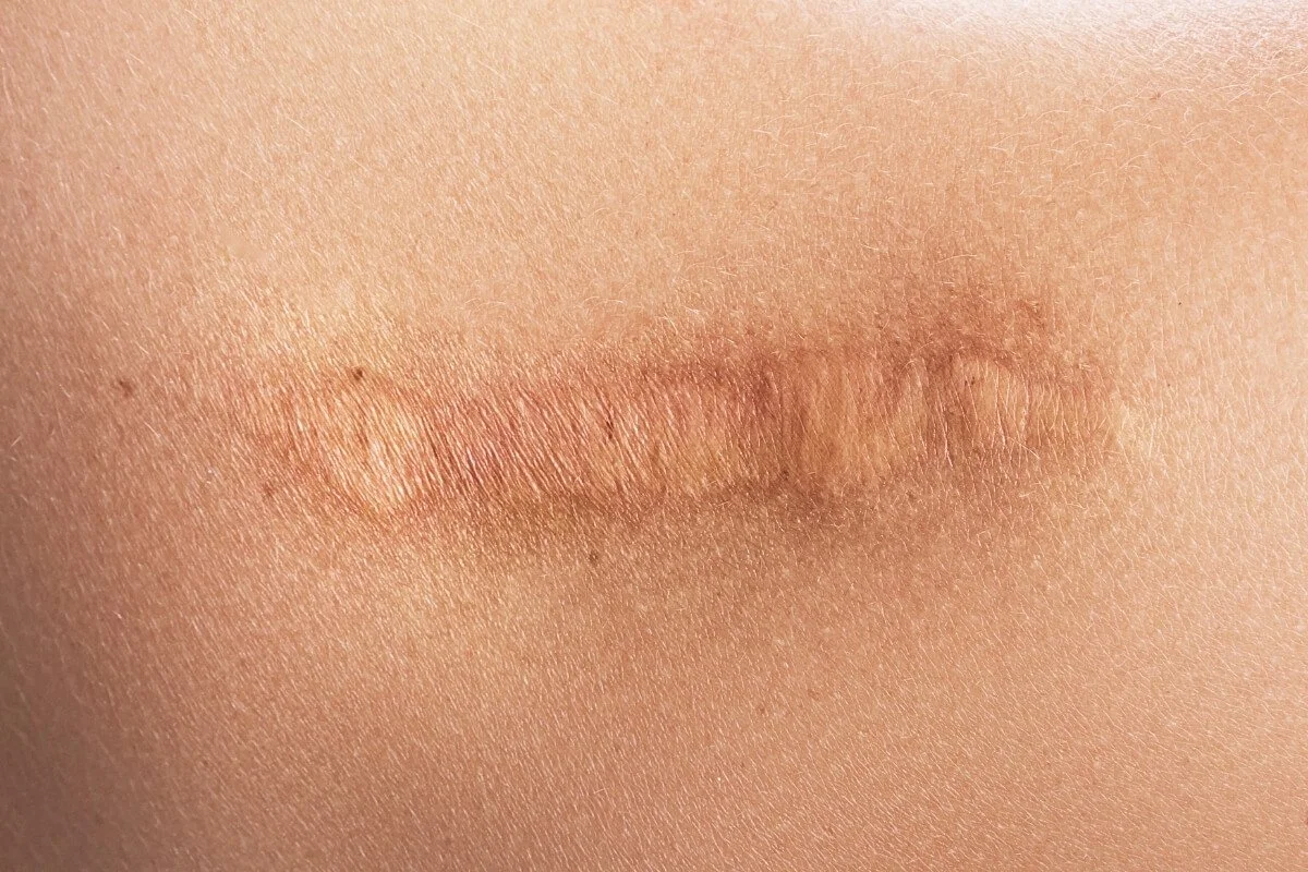 Healed scar tissue formed during the yoga injury proliferation phase