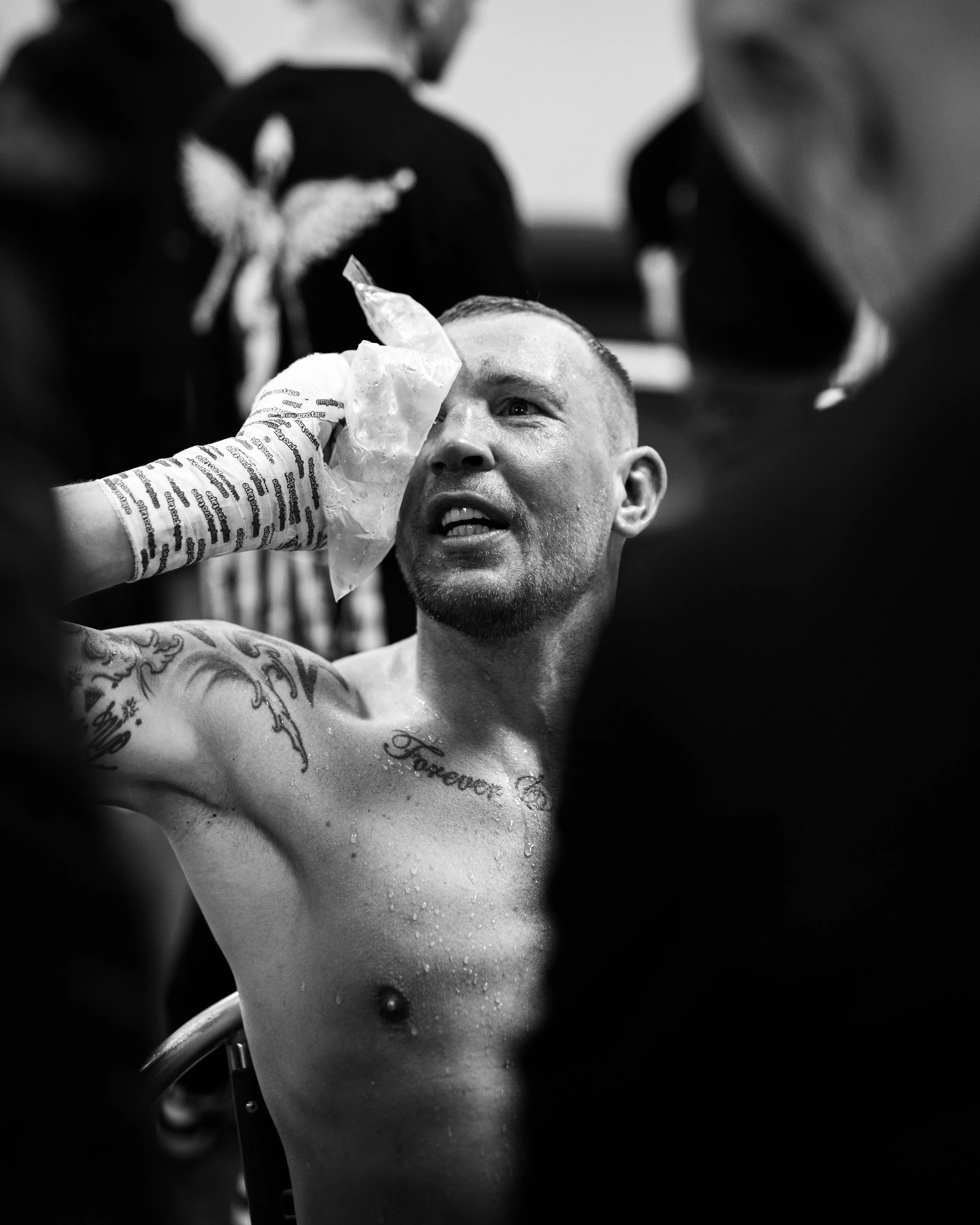 James Todd icing his eye after a barnstorming performance against Aaron Bowen