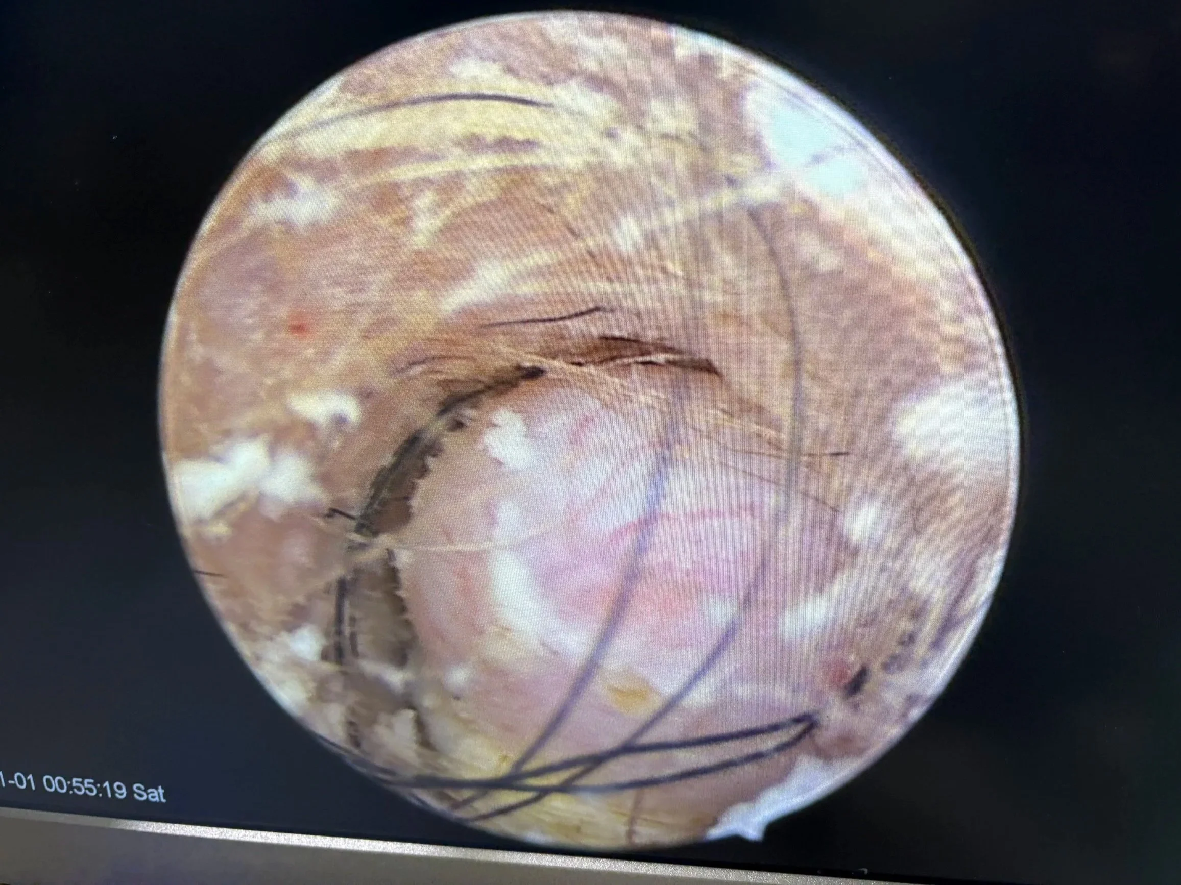 Close-up of a surgical view inside a dog's ear, showing a growth inside the ear canal.