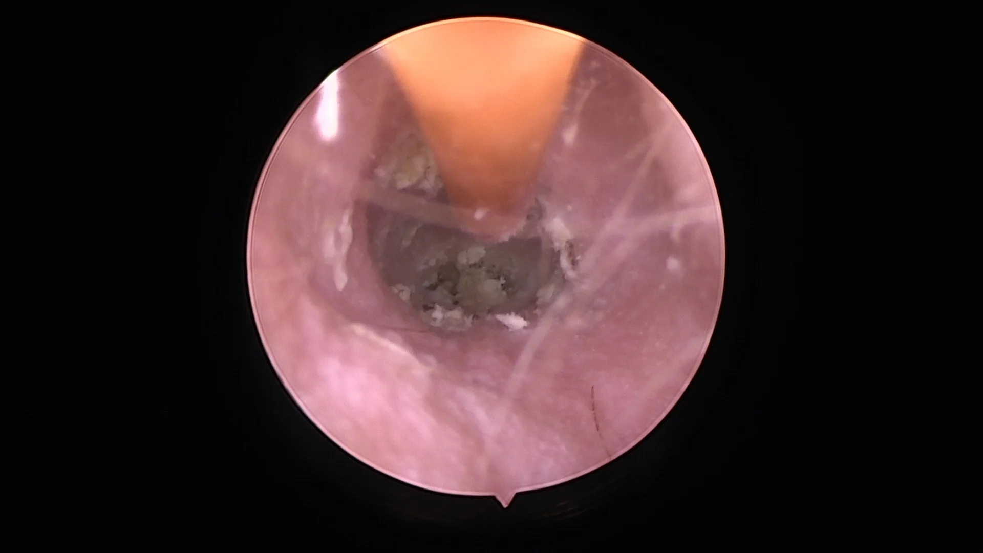 Flushing an ear canal clean with a soft catheter via our video-otoscope.