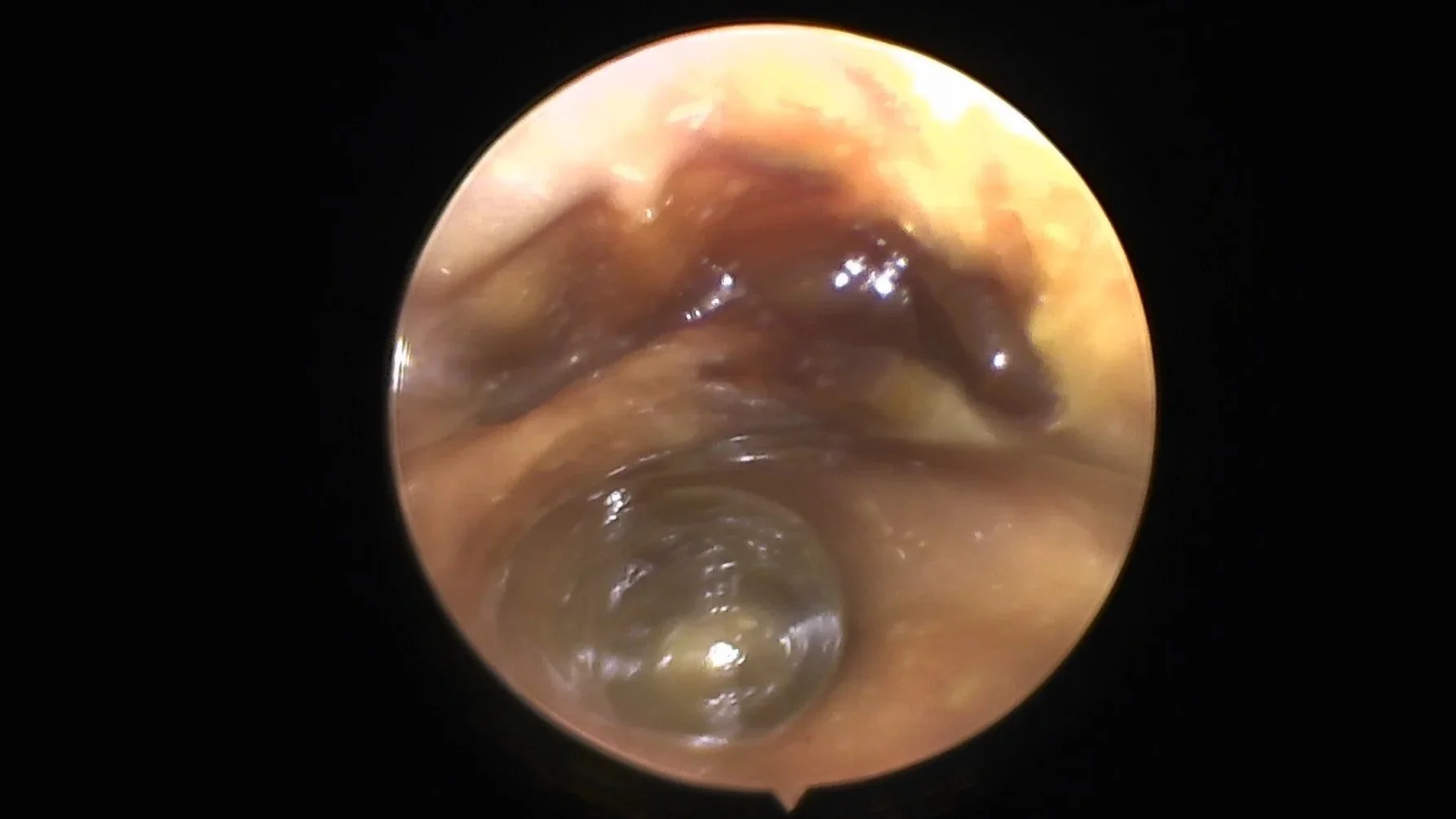 View of the inside of a dog's ear canal with a chronic bacterial infection and purulent debris.