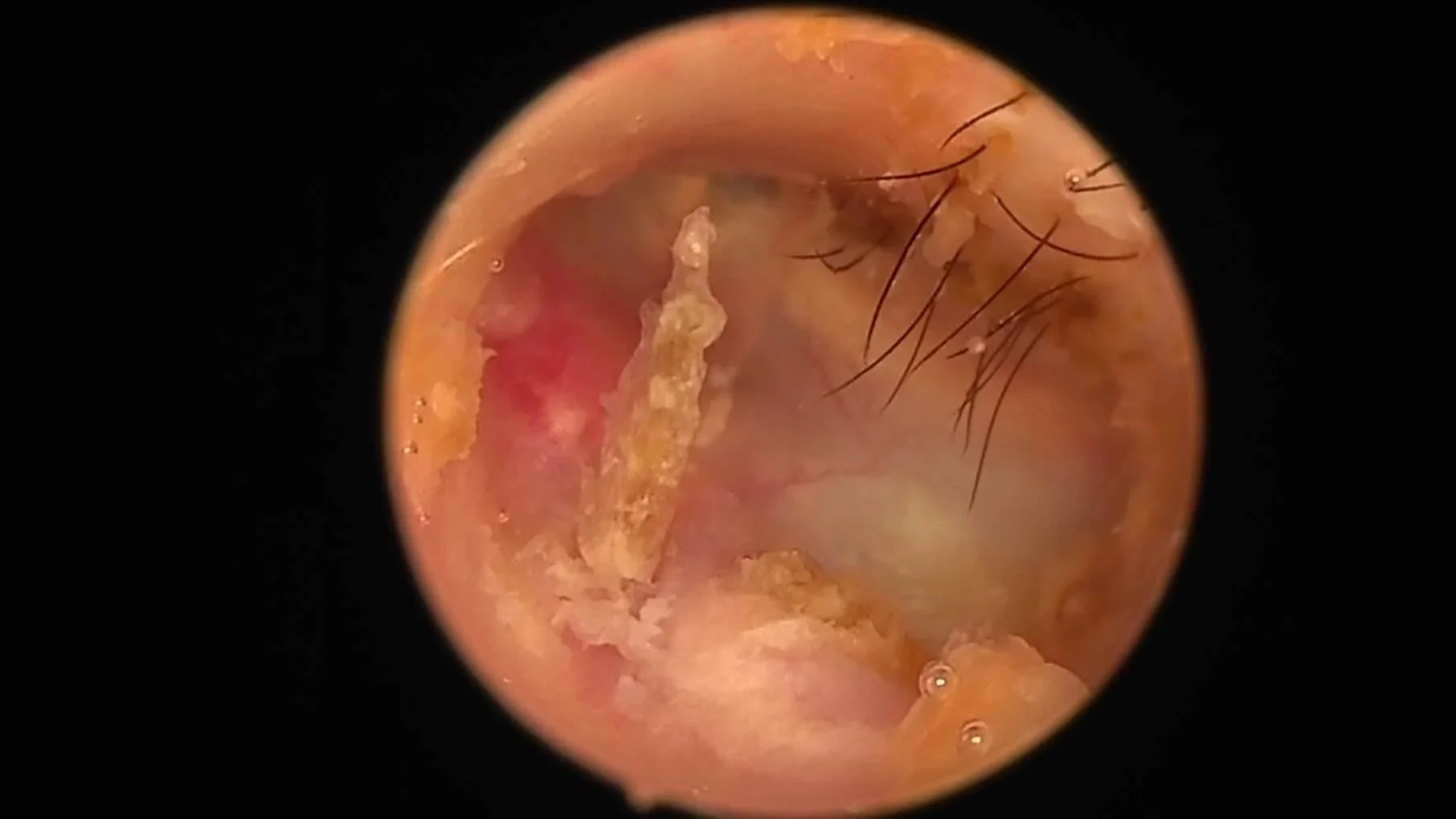 An inflamed and thickened tympanic membrane visualised during an ear flush.