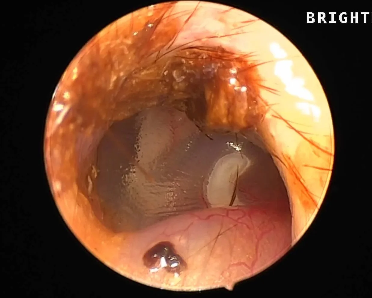A normal dog's tympanic mmbrane (eardrum).