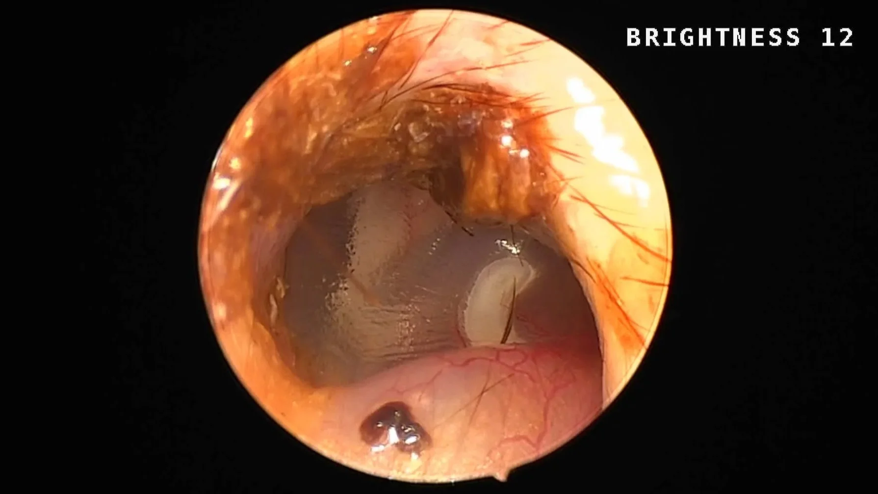 Endoscopic view of a dog's ear drum showing the pars tensa and pars flaccida of the tympanic membrane.  The manubrium of the malleus is clearly visible.