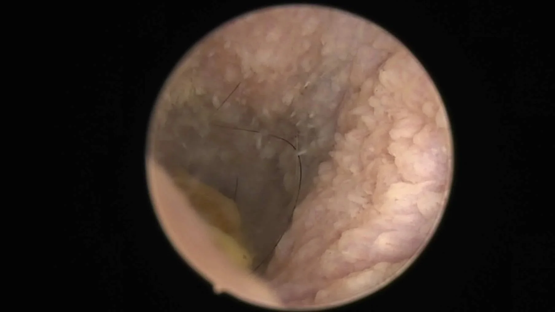 Chronic inflammatory changes of the vertical ear canal of a dog.