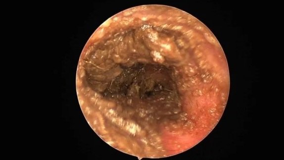 Close-up of an ear canal showing an ear with wax buildup and inflammation.