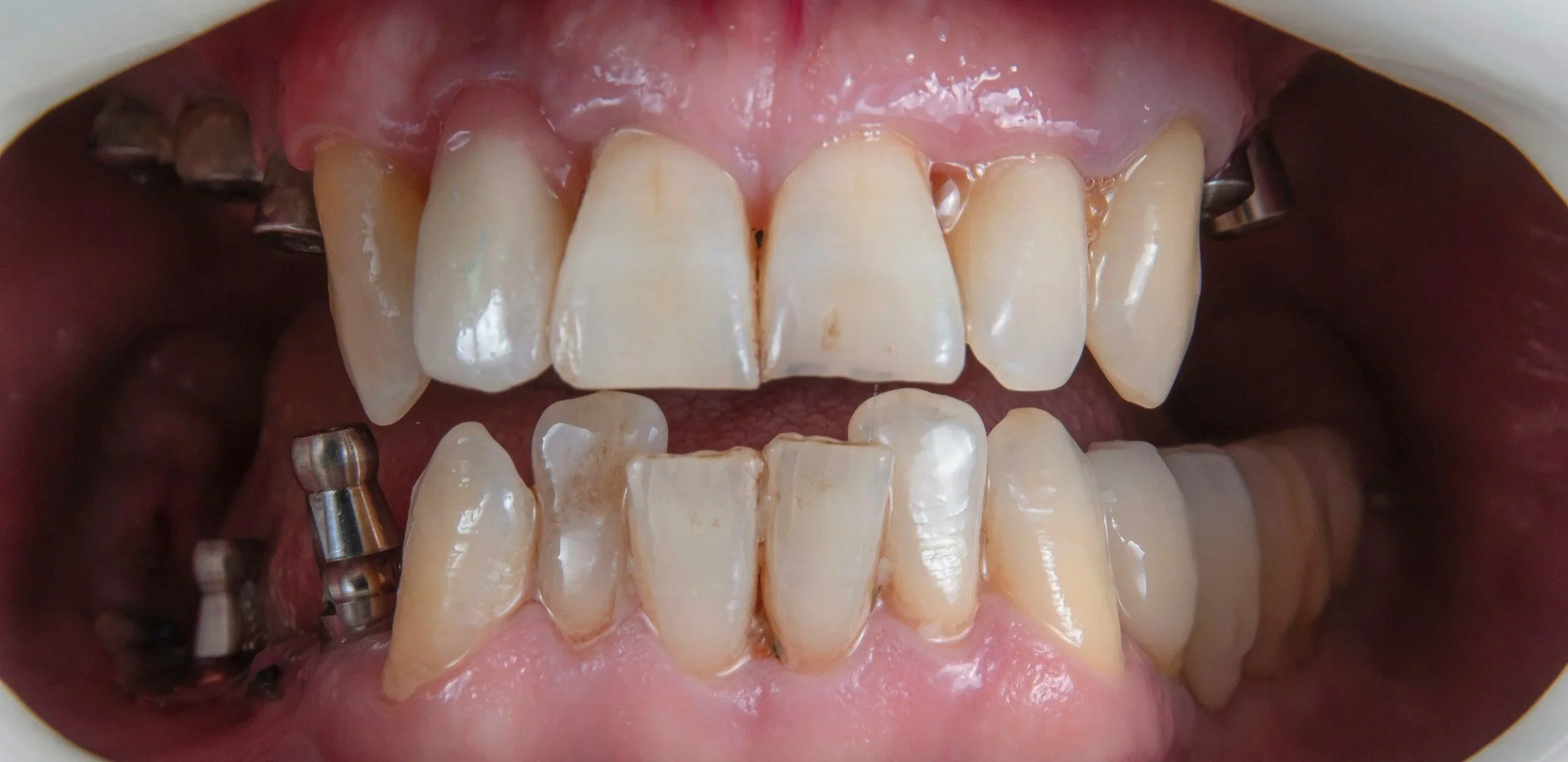Close-up of a mouth showing upper and lower teeth, some are chipped or broken, and dental implants or screws are visible on the upper left and lower left sides. missing teeth