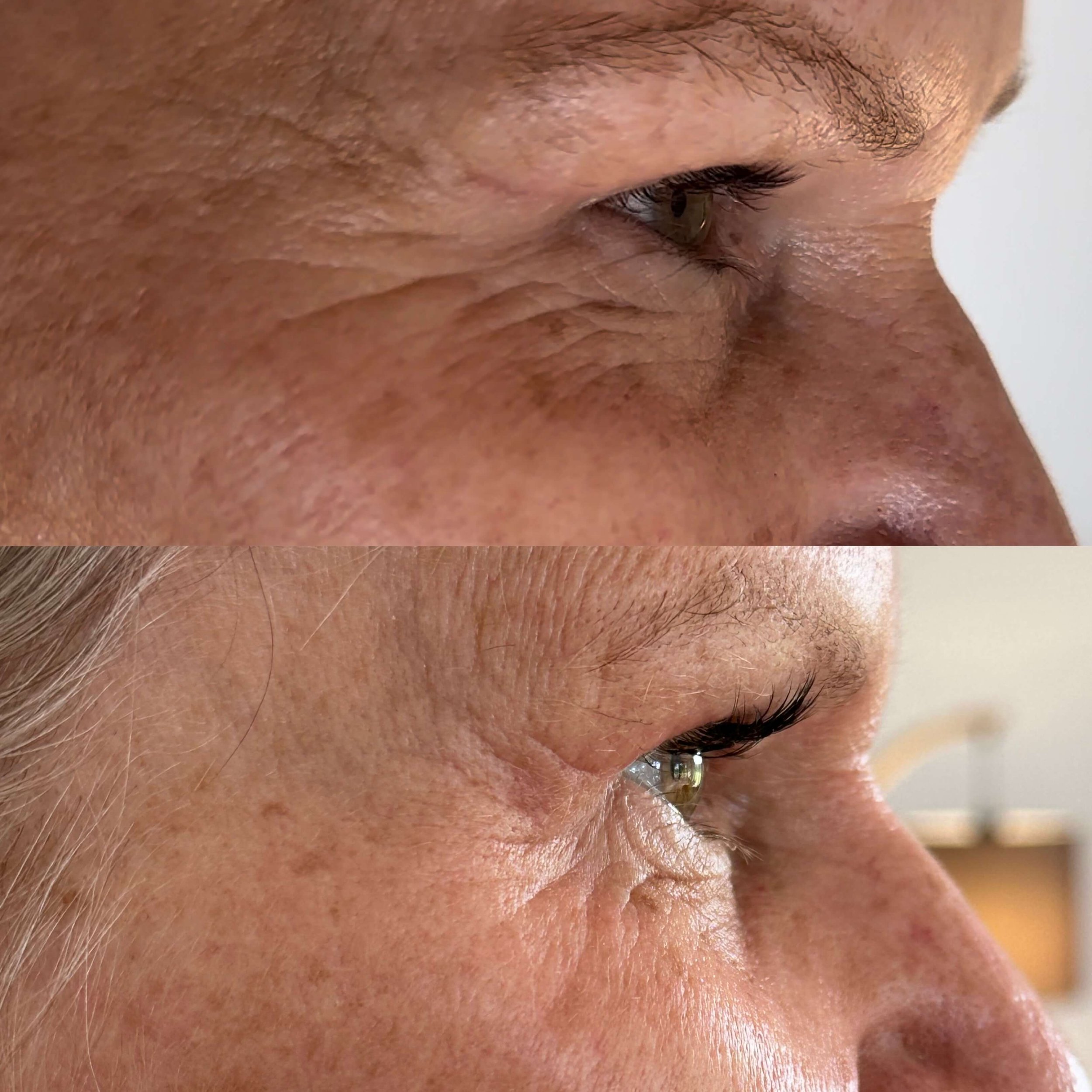 wrinkle-treatment.JPG