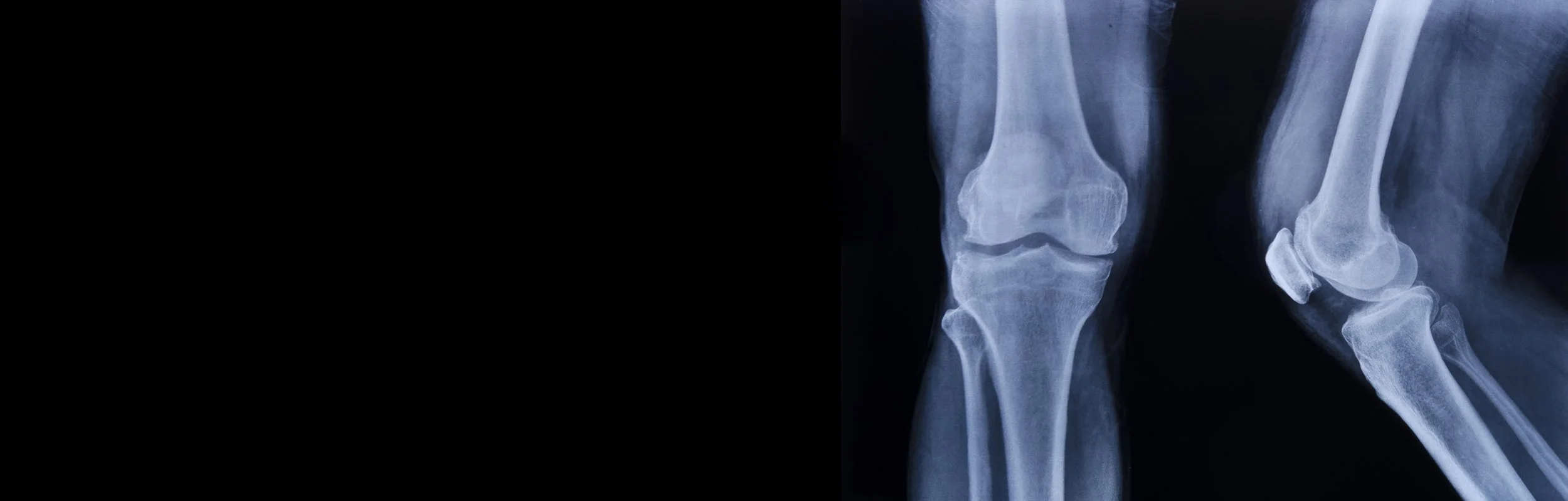 Patella knee Surgery Warrnambool Dr Nathan Kirzner