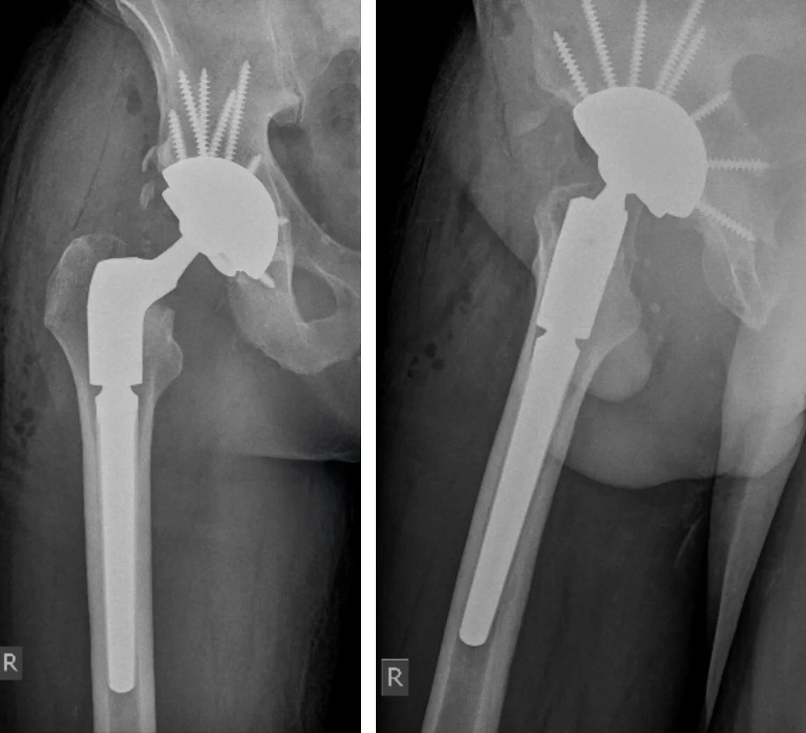 Hip Replacement Surgery Warrnambool Dr Nathan Kirzner