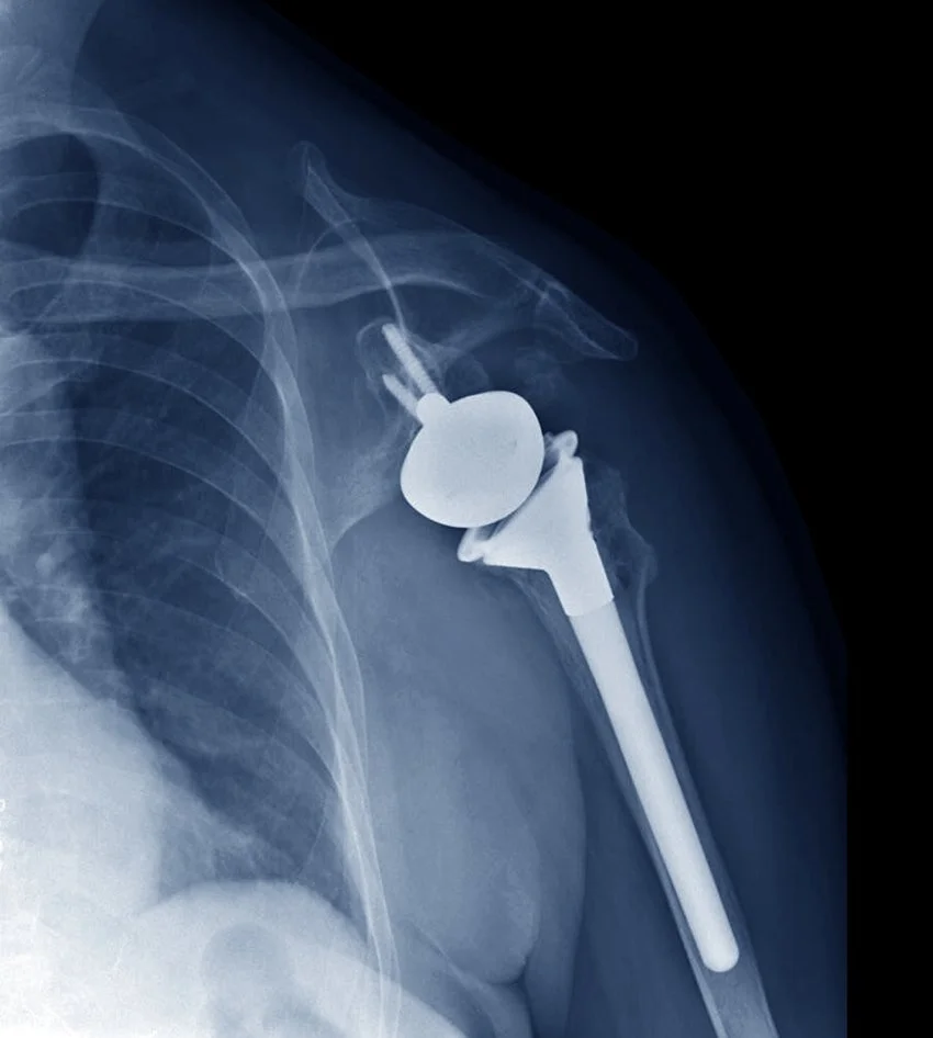 Shoulder Replacement Surgery Warrnambool Dr Nathan Kirzner