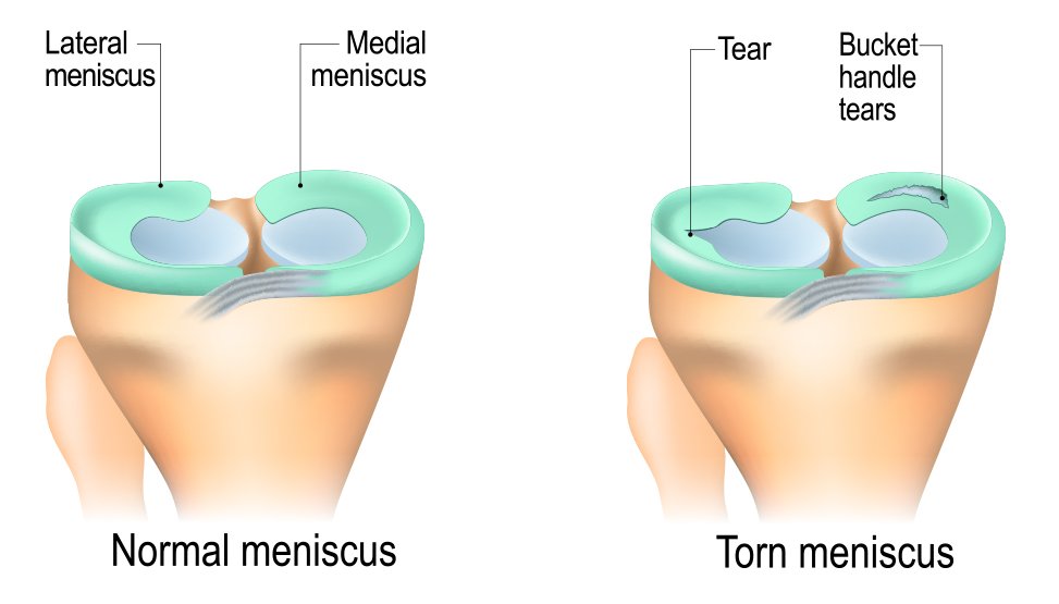 Meniscus knee Surgery Warrnambool Dr Nathan Kirzner