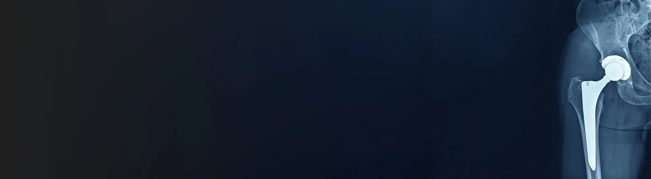 Hip Replacement Surgery Warrnambool Dr Nathan Kirzner