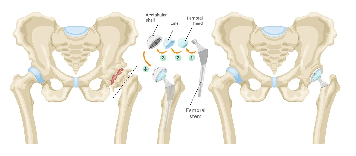 Hip Replacement Surgery Warrnambool Dr Nathan Kirzner