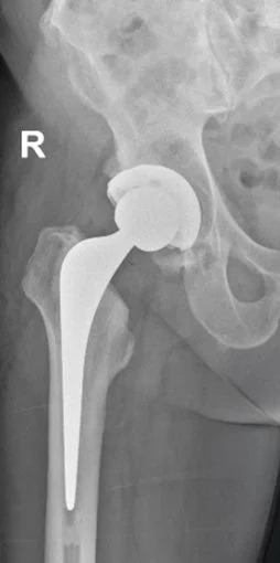 Hip Replacement Surgery Warrnambool Dr Nathan Kirzner