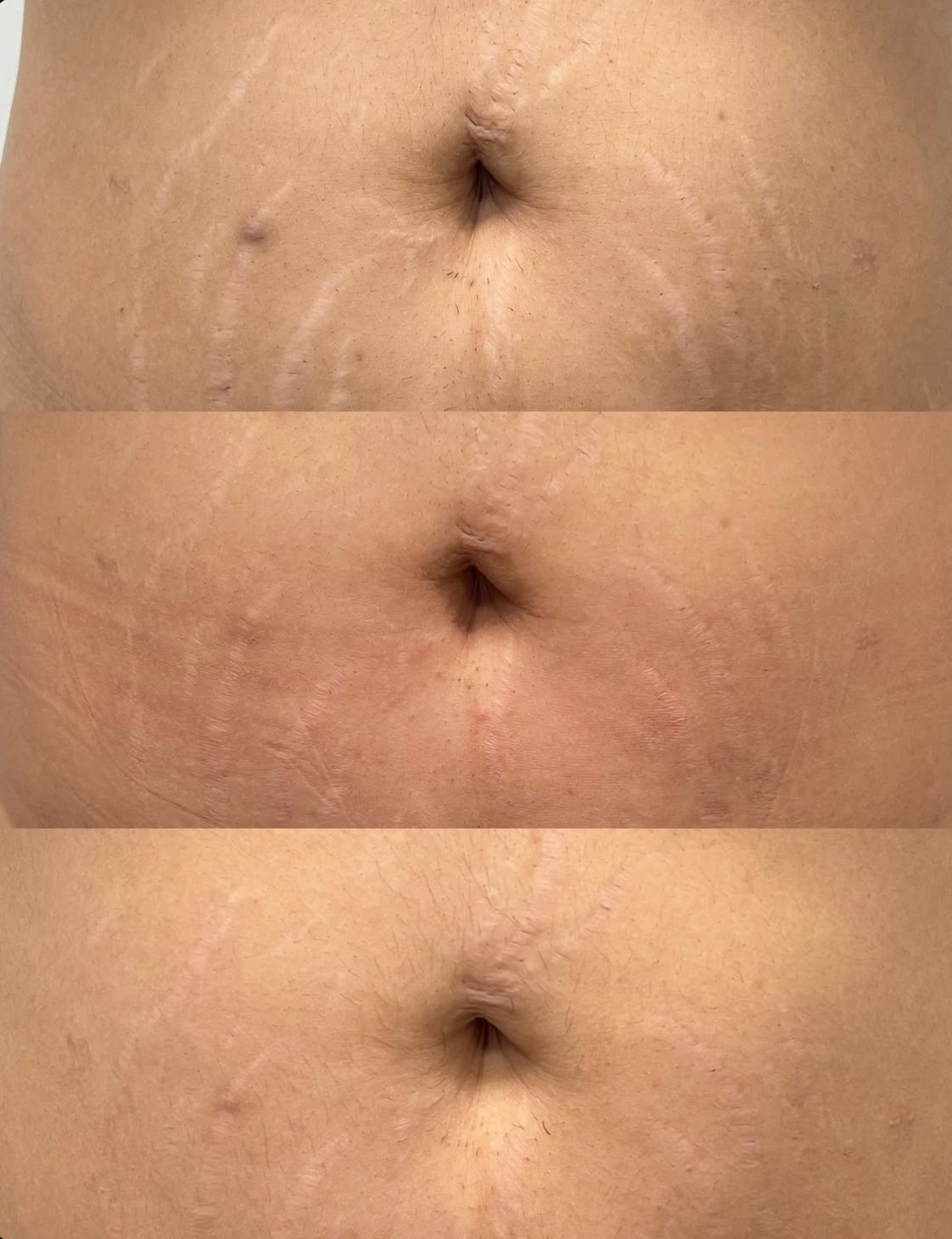 Inkless Stretch Mark Revision