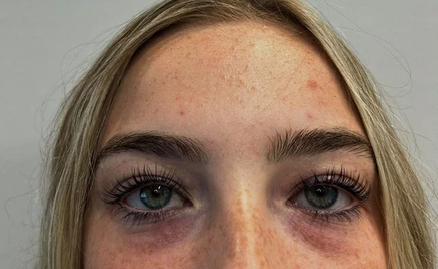 Close-up of a woman's eyes and forehead showing dark circles and redness under her eyes and freckles on her forehead.