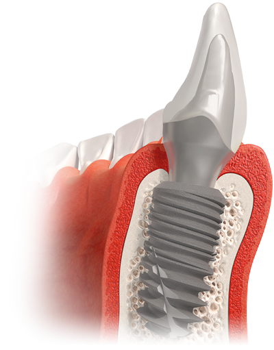 Cross-section of a tooth showing a dental implant with screws inserted into the jawbone, surrounding gum tissue, and a dental crown on top.