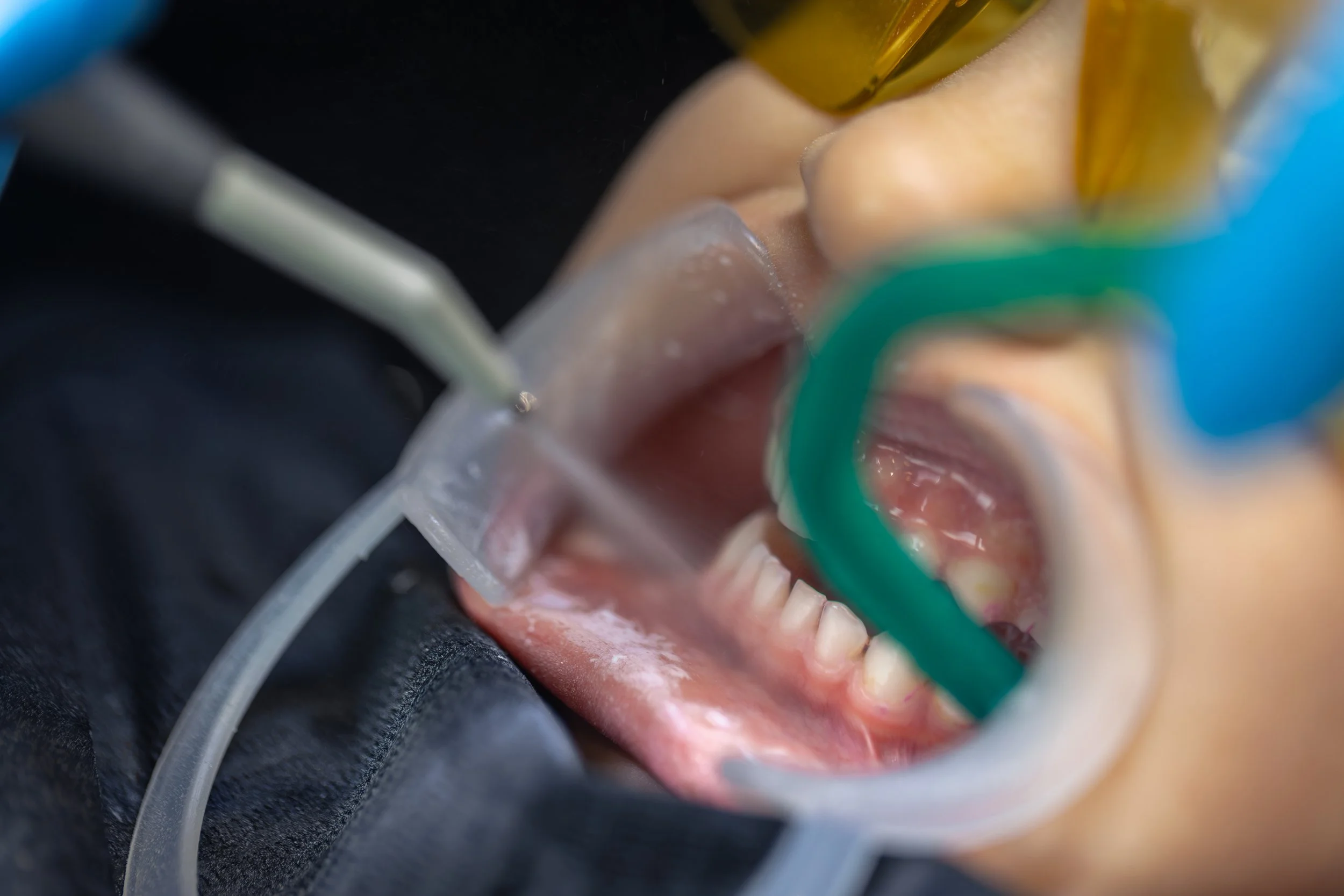 Close-up of a dental procedure where a patient is wearing dental goggles and a rubber dam, with a dental drill or syringe near the open mouth.