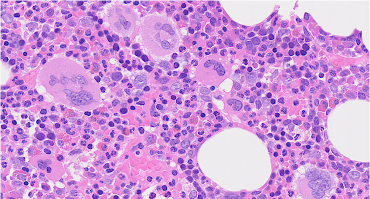 Microscopic view of human tissue with numerous cells stained purple and pink, showing cellular structure and cavities.