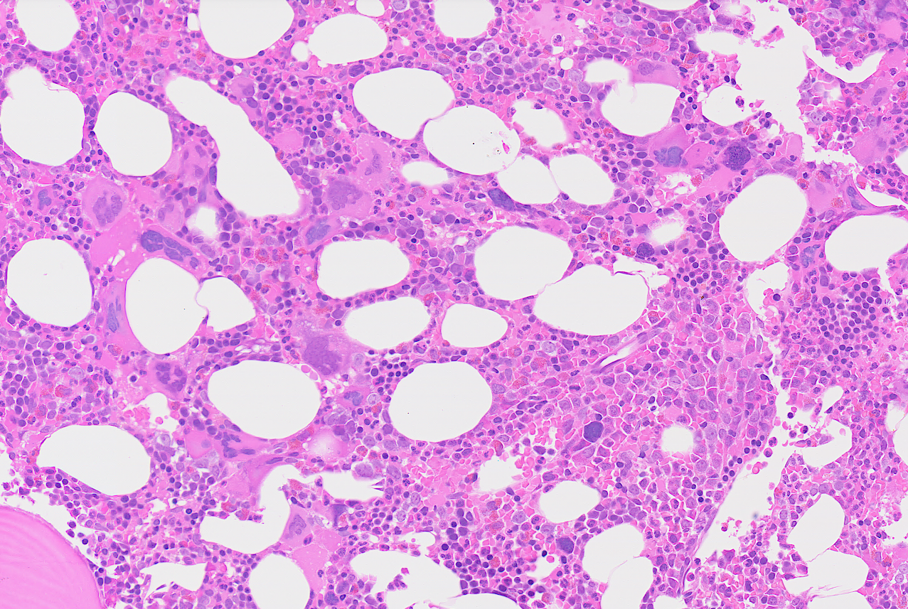 Microscopic view of bone marrow showing cells and large empty spaces.