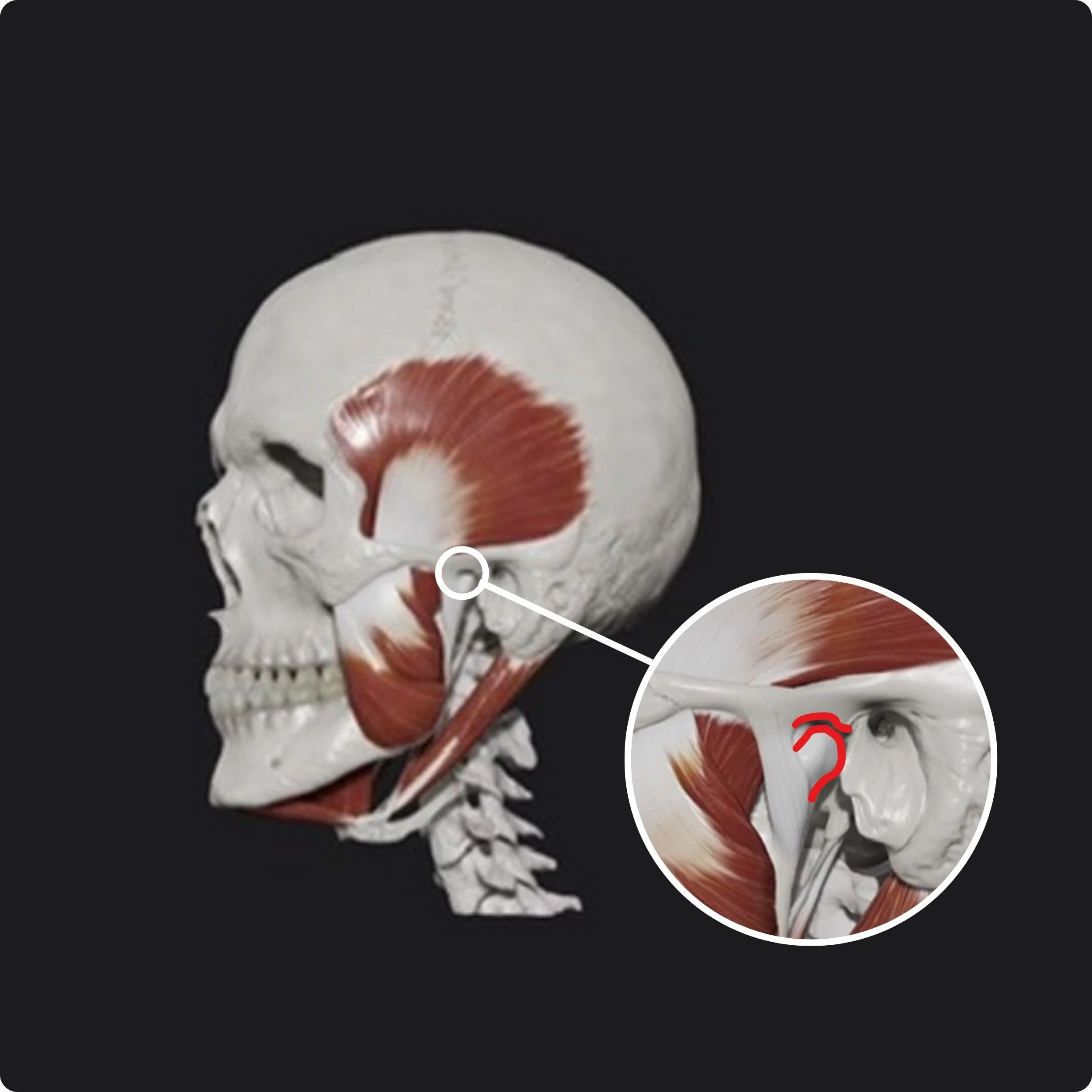 image of a skull with a close up image of the temporomandibular joint