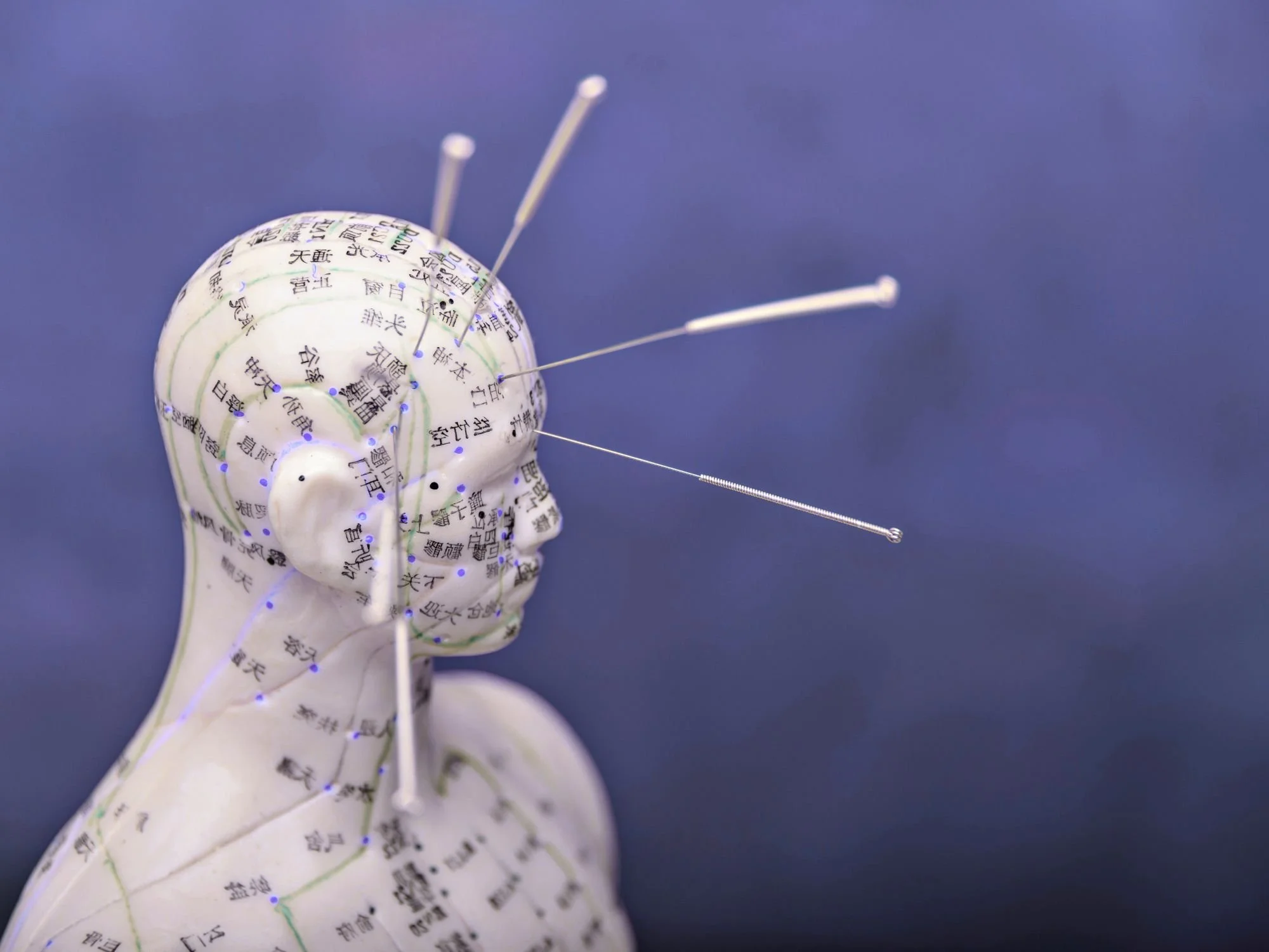 Acupuncture needles placed for TMJ pain and neck muscle release