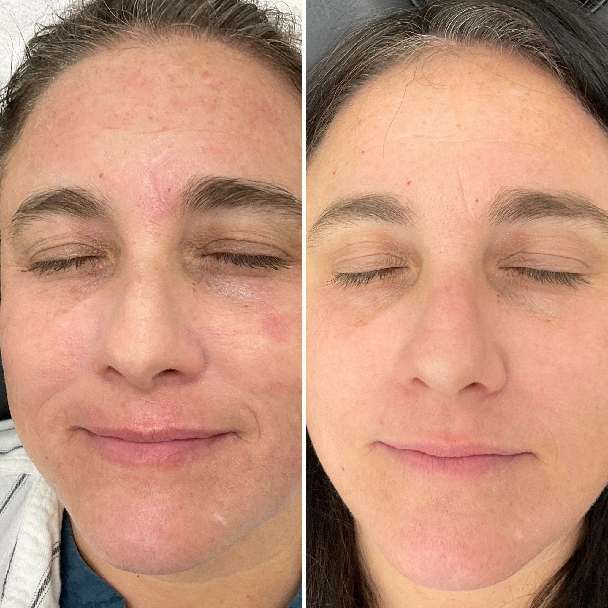Side-by-side comparison of a woman's face before and after skincare treatment, showing reduced redness and smoother skin.