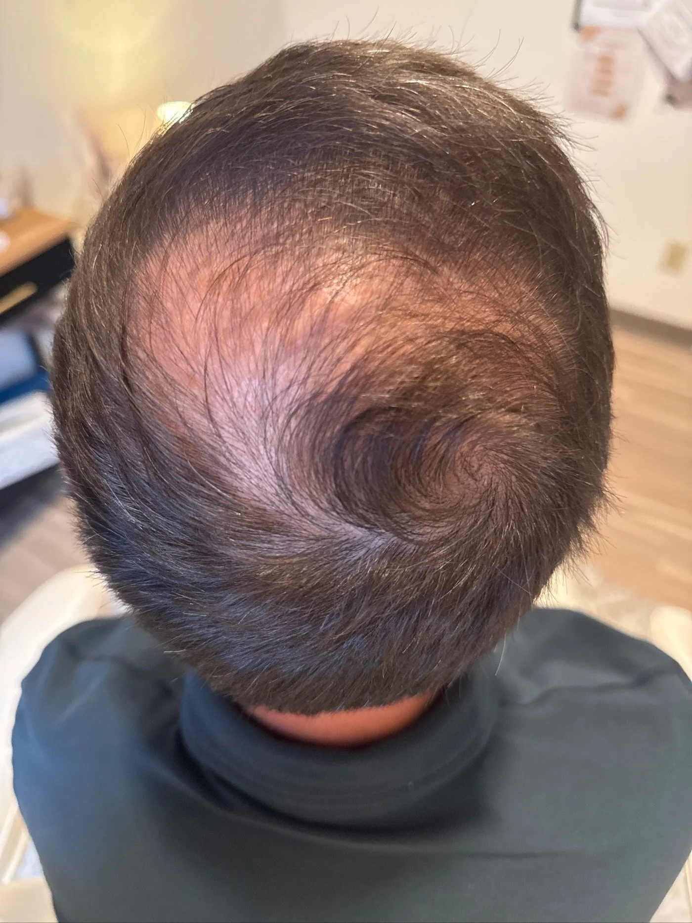 Top view of a person's head showing the results of Rocktown Medical Spa's hair restoration treatment.