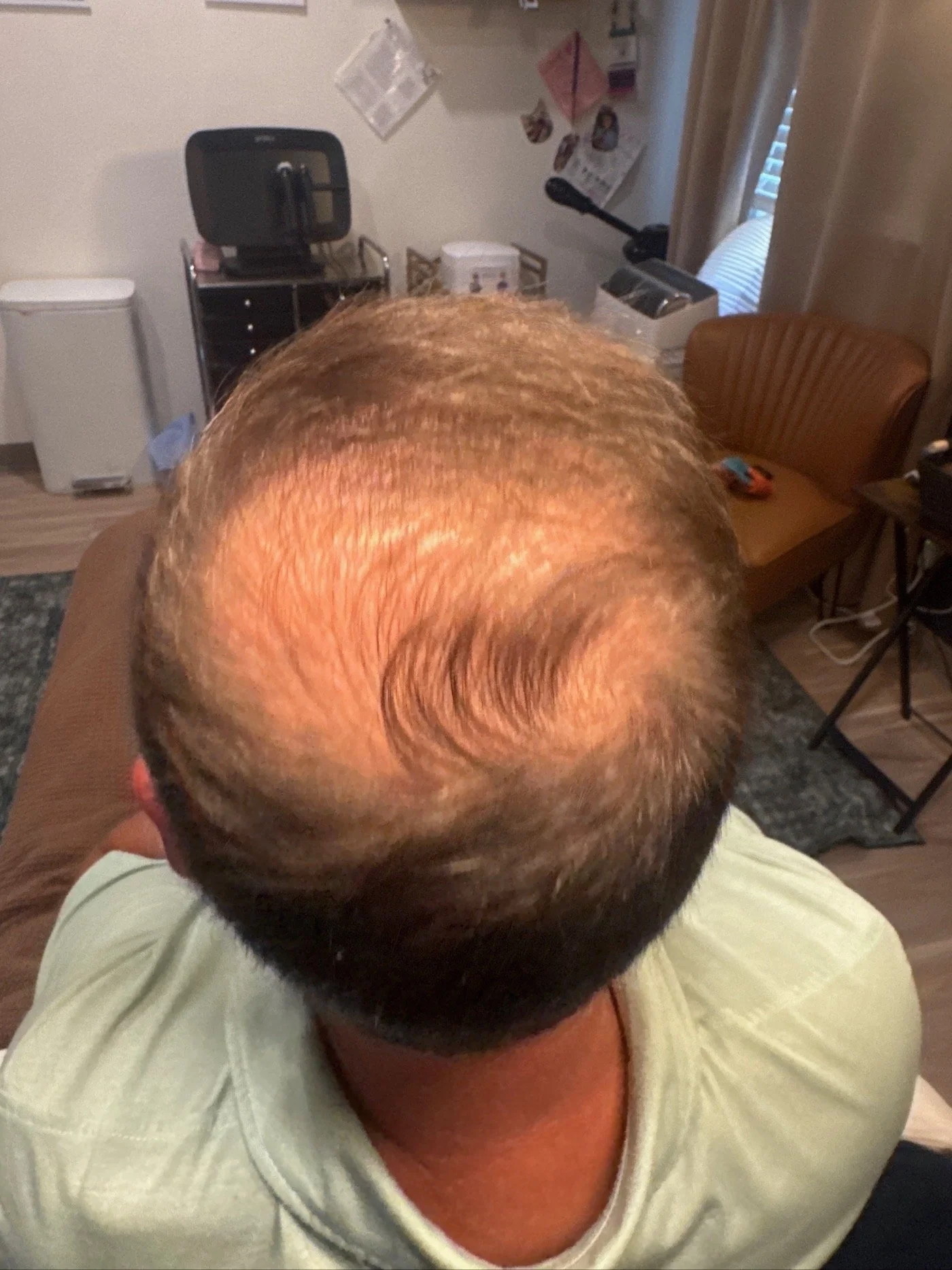 Top view of a person's head showing their hair before Rocktown Medical Spa's hair restoration treatment.