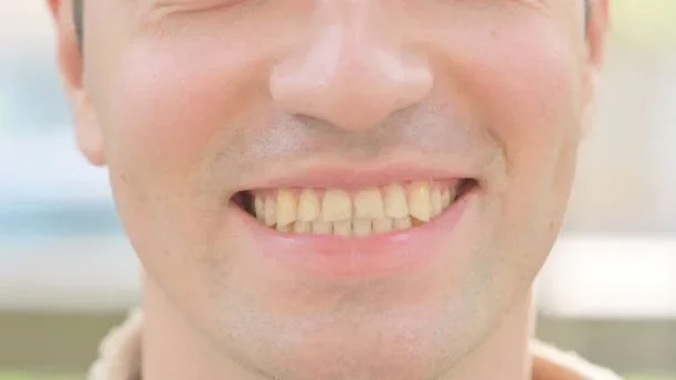 Common Causes of Tooth Discoloration Explained by Valencia Dentists