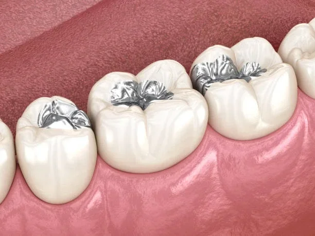 Health Benefits of Replacing Silver Fillings: Valencia Expert Review