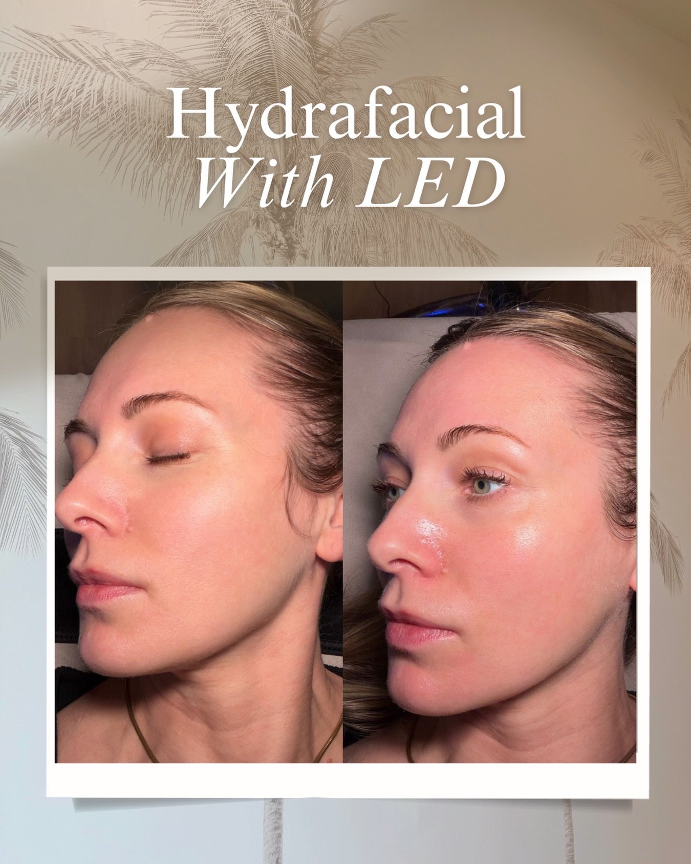 Hydrafacial isn&rsquo;t just a facial, it&rsquo;s a skin treatment✨ HydraFacial is a gentle yet powerful treatment that uses a patented vortex tip to cleanse, exfoliate, extract, and hydrate all in one treatment. All of our facials at Sol &amp; Palm 
