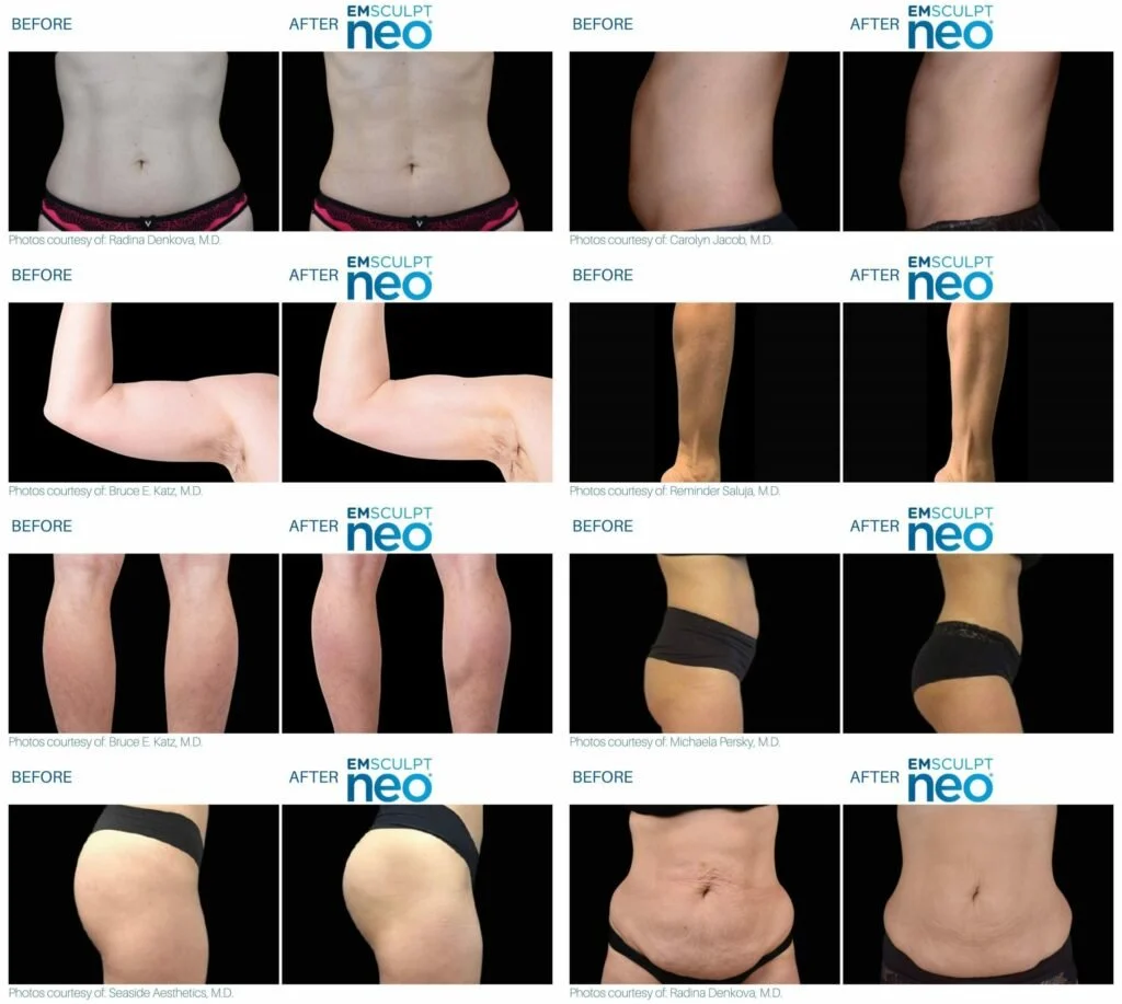 Compilation of before and after photos showing body contouring results including abdomen, arms, legs, and waist, using EM Sculpt Neo technology.