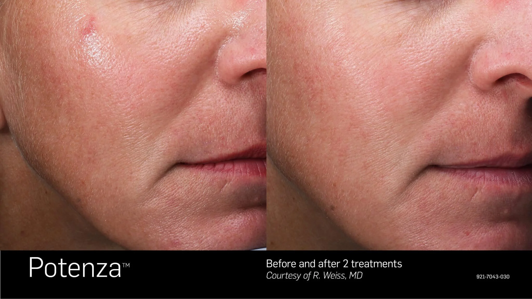 Close-up comparison of a woman's face showing skin before and after two Potenza skin treatments, with visible improvement in skin texture and redness.