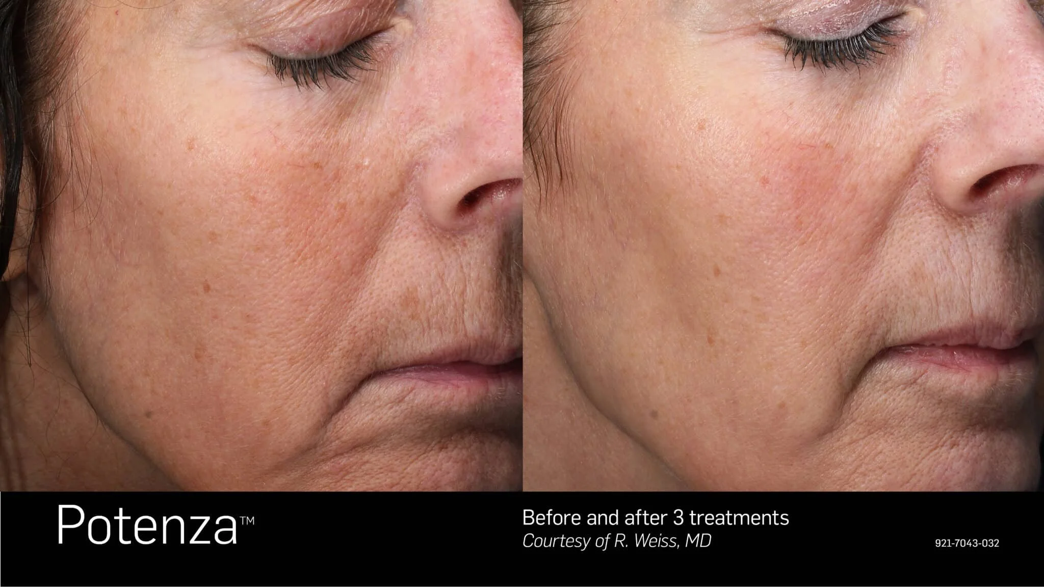Side-by-side comparison of a woman's face showing skin improvement after three treatments with Potenza, a skin treatment device.