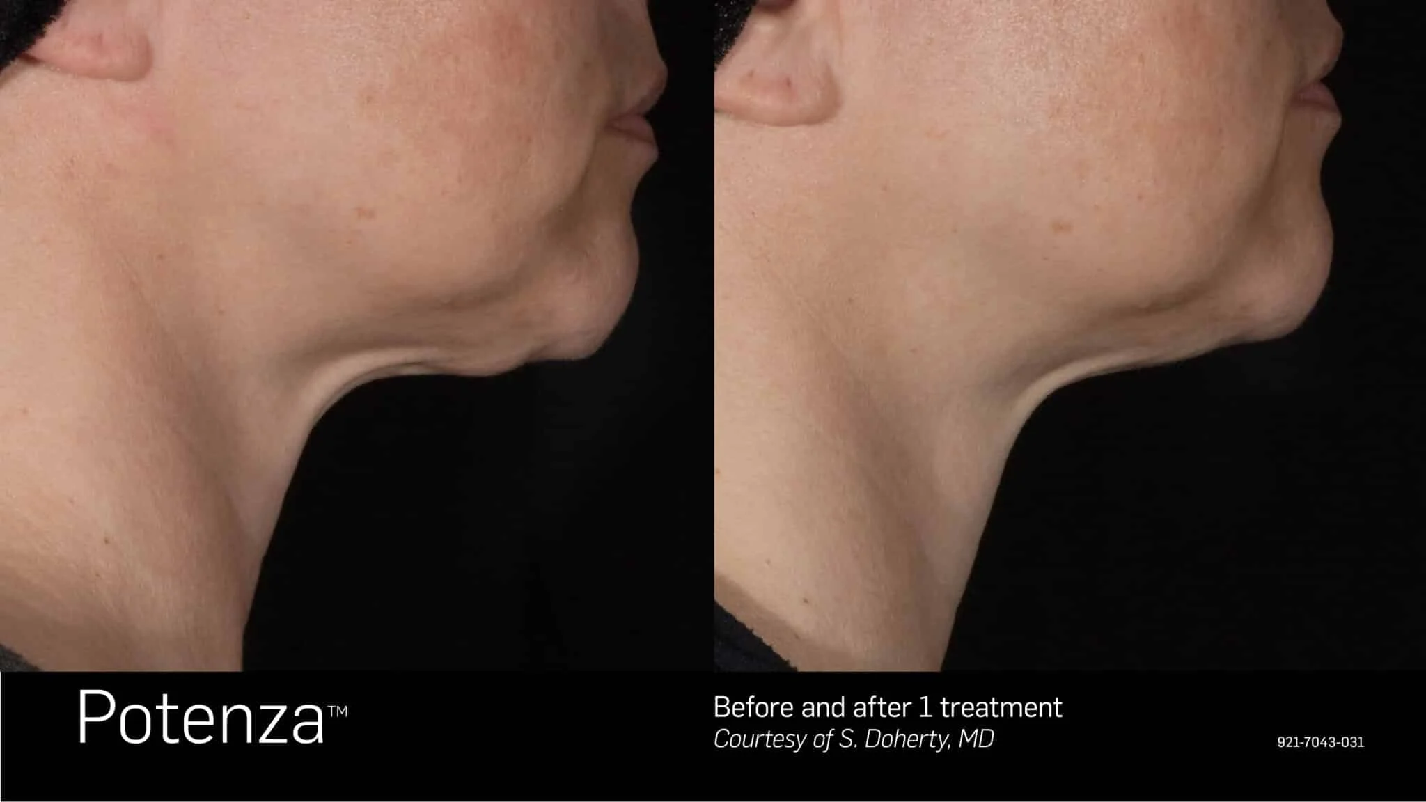 Side-by-side comparison of a person's chin and neck area showing before and after one treatment with Potenza, a medical device, as credited to S. Doherty, MD.