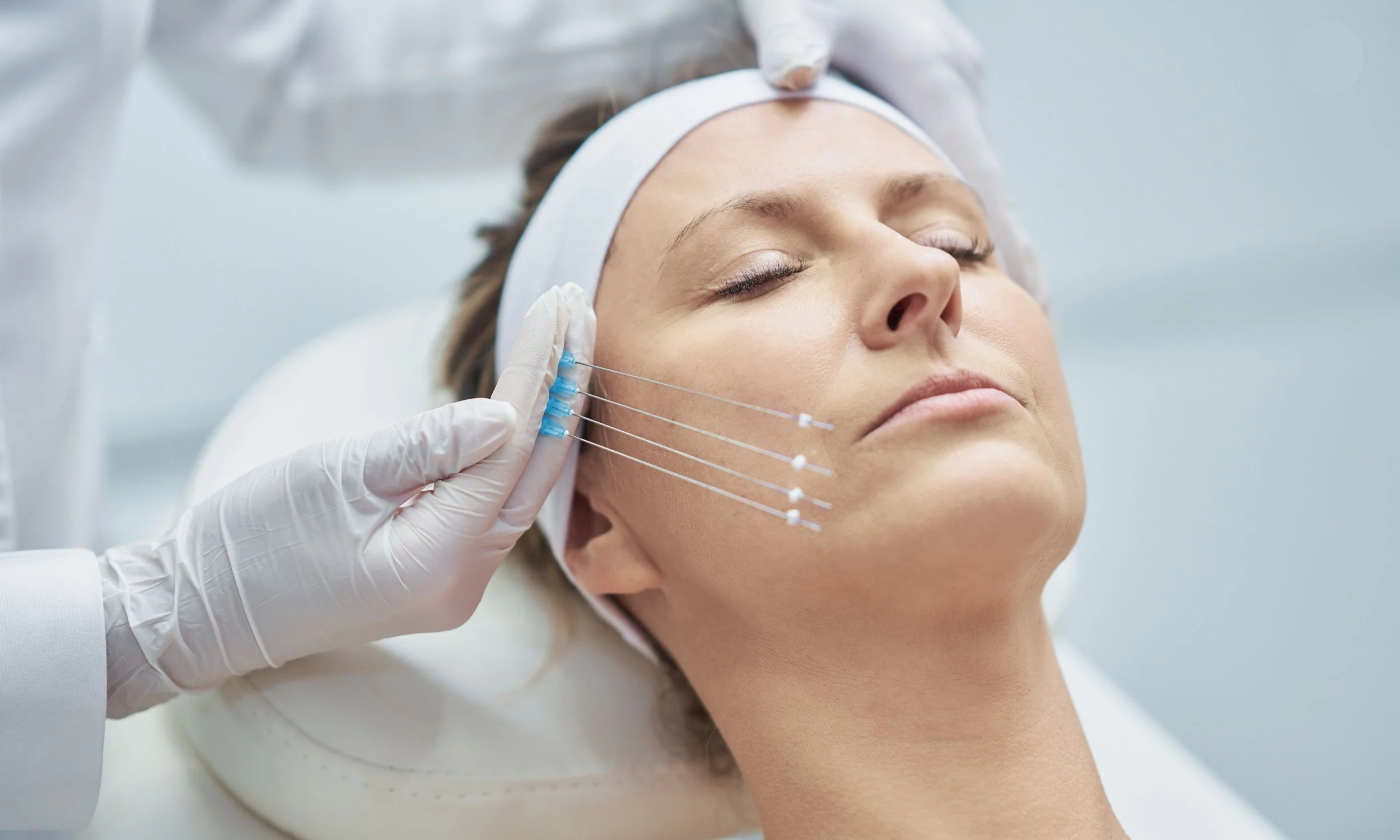 A woman receiving a facial cosmetic treatment with multiple small injections on her cheek from a healthcare professional wearing gloves.