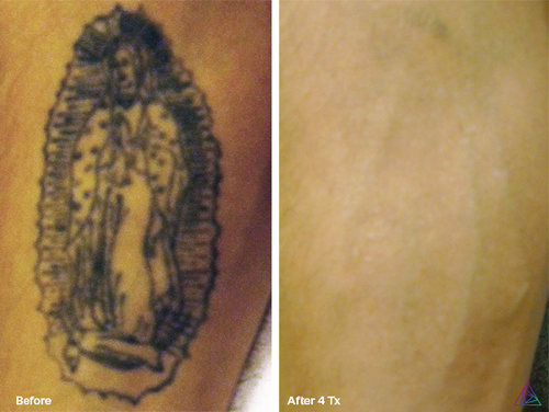 Before and after tattoo removal result