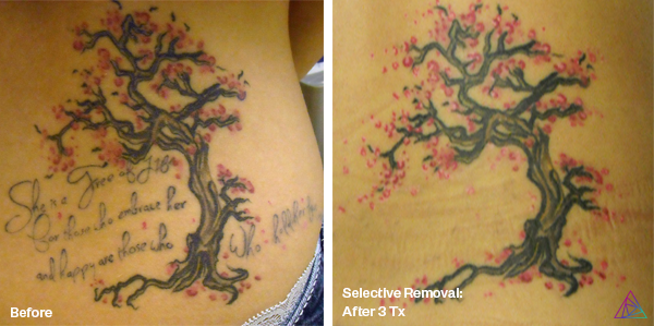 Before and after tattoo removal result