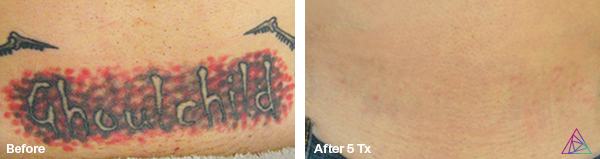 Before and after tattoo removal result