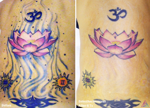 Before and after tattoo removal result