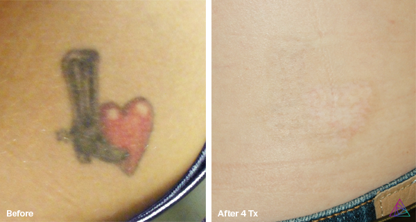Before and after tattoo removal result