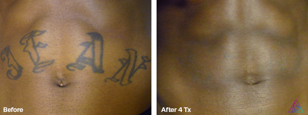 Before and after tattoo removal result