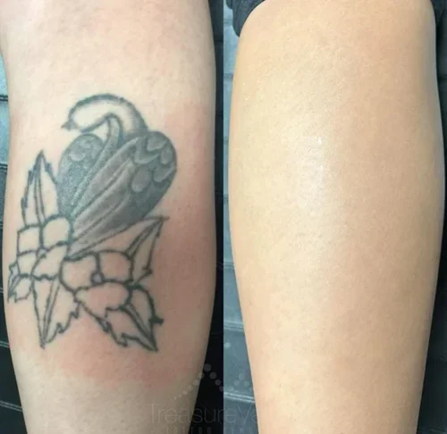 Before and after tattoo removal result