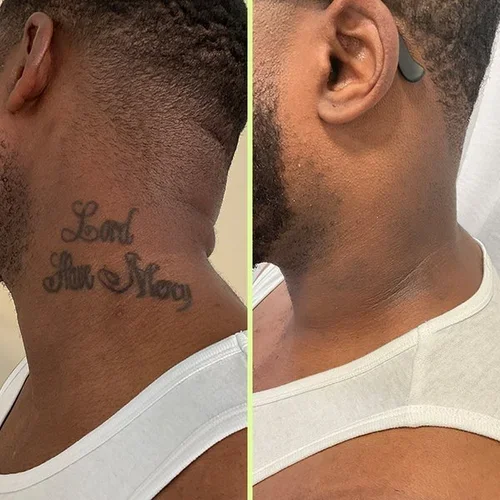 Before and after tattoo removal result