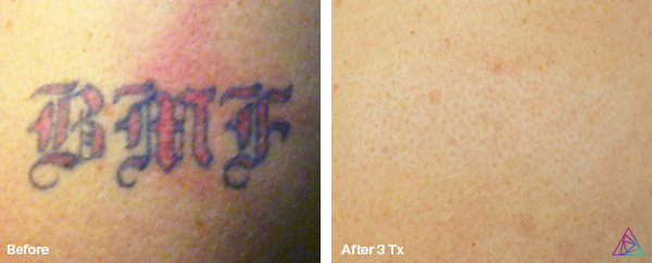 Before and after tattoo removal result