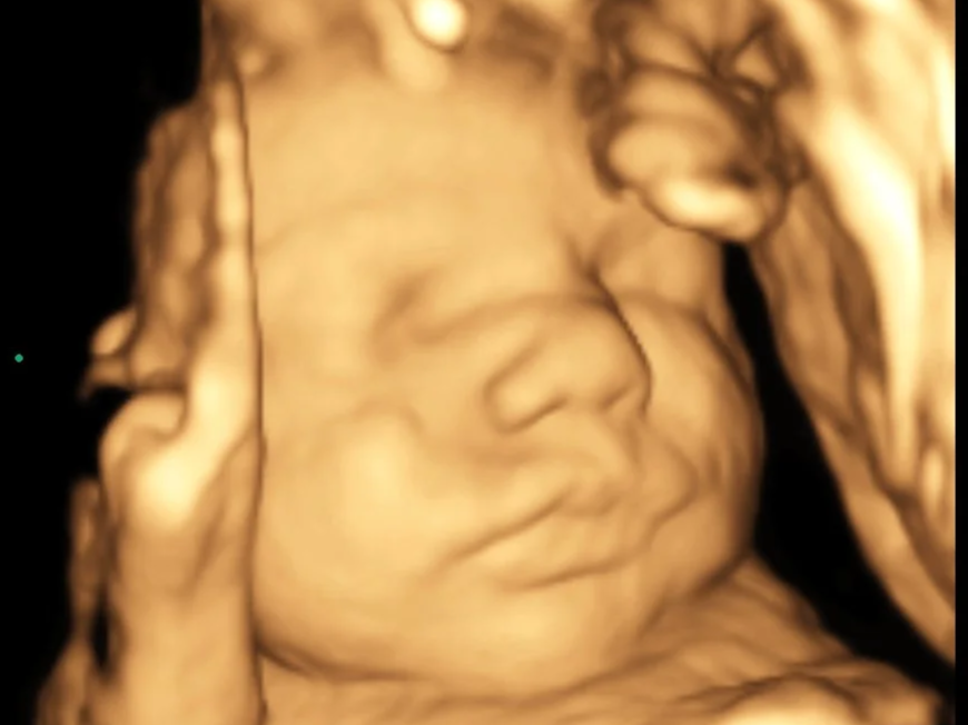3D Ultrasound